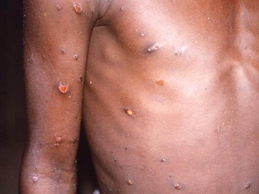 Govt issues guidelines on monkeypox, stresses on surveillance and rapid identification