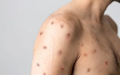 WHO declares mpox a global public health emergency for second time in two years