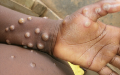 Africa public health body declares mpox emergency