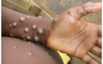 WHO launches global strategic preparedness & response plan to contain Mpox outbreak