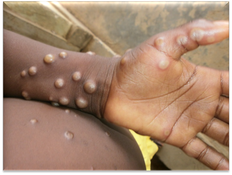 WHO launches global strategic preparedness & response plan to contain Mpox outbreak