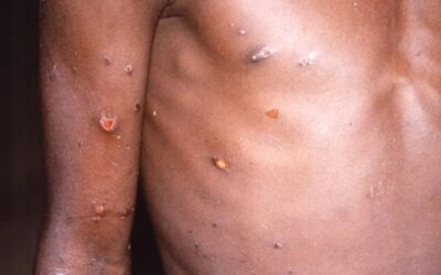 Mpox emergency may add to economic, fiscal challenges in some African sovereigns: Fitch