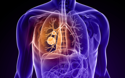 Of all lung cancer patients, 40 pc never smoked: BJP MP demands national screening programme